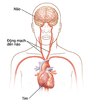 Hình ảnh phía trước của đầu và phần trên của cơ thể cho thấy các động mạch cảnh, tim và não.